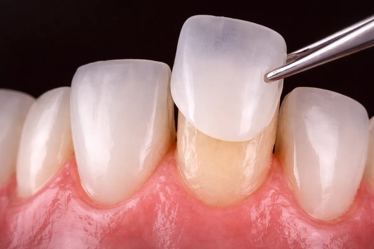 Estética Dental