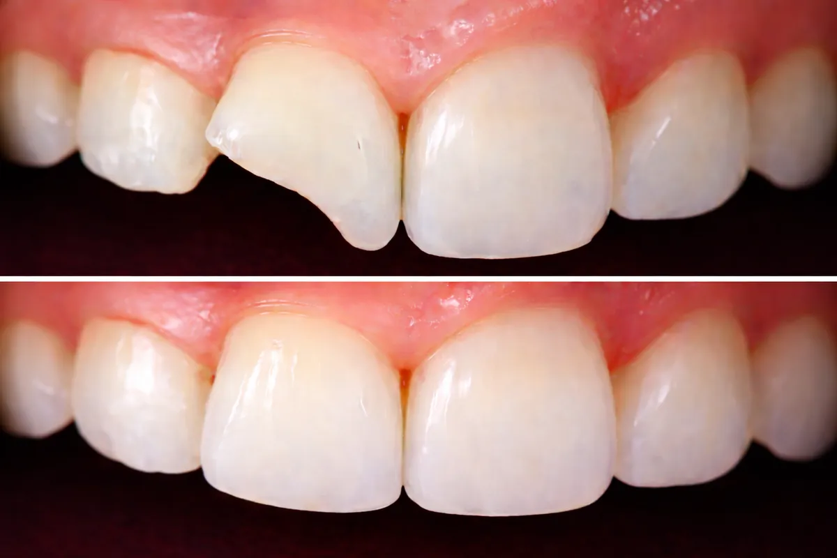 Restauração Dentária