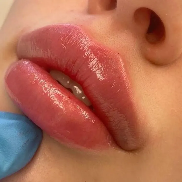 Harmonização Orofacial